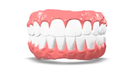 Overdenture Implantare in Resina Acrilica
