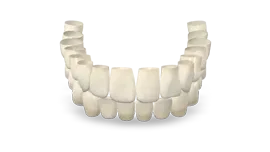 Zirconia-Ceramica (PFZ)